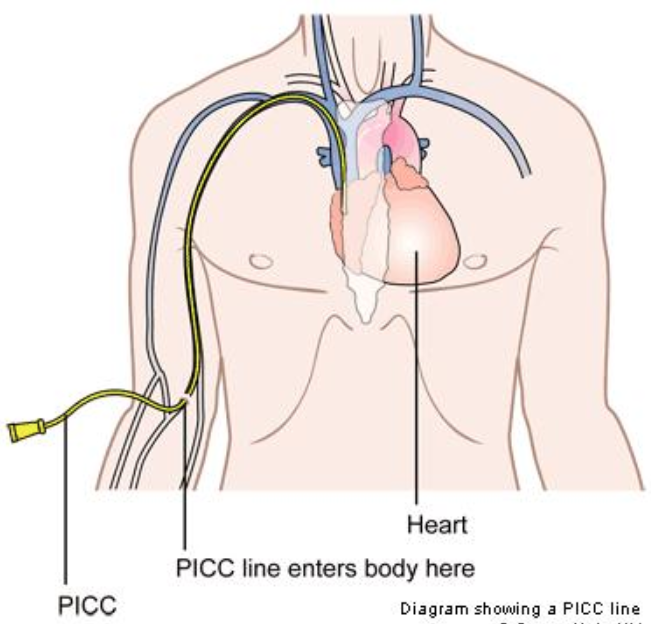 picc-giai-phap-hieu-qua-cho-dieu-tri-dai-han-voi-loi-ich-vuot-troi